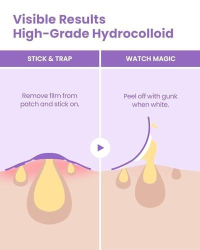 GLAM UP Spotless Patch – Hydrokolloid-Pflaster für große Aknebereiche, Wangen, Körper, Mitesser – Tierversuchsfrei & vegan (12 Stück)