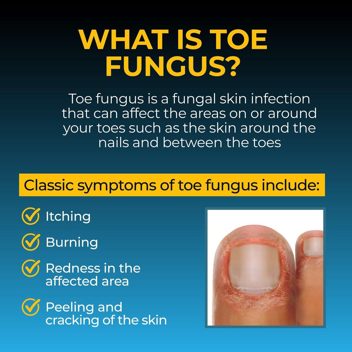 Fungi-Nail Anti-Fungal Fußspray – Tötet Pilze, die zu Nagel- und Fußpilz führen können, mit Tolnaftat & klinisch erwiesen – 30 ml