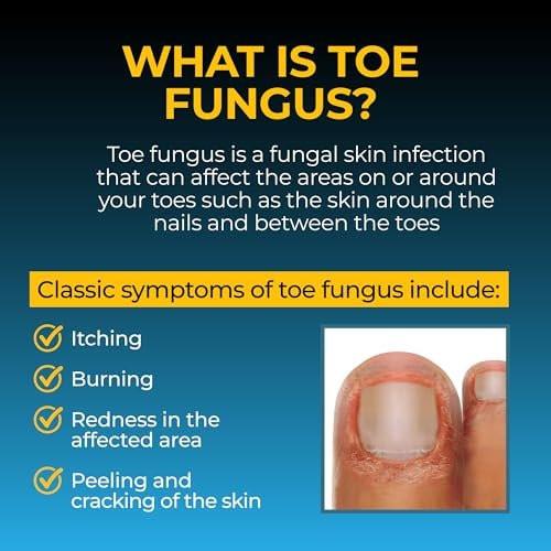 Fungi-Nail Anti-Fungal Fußspray – Tötet Pilze, die zu Nagel- und Fußpilz führen können, mit Tolnaftat & klinisch erwiesen – 30 ml