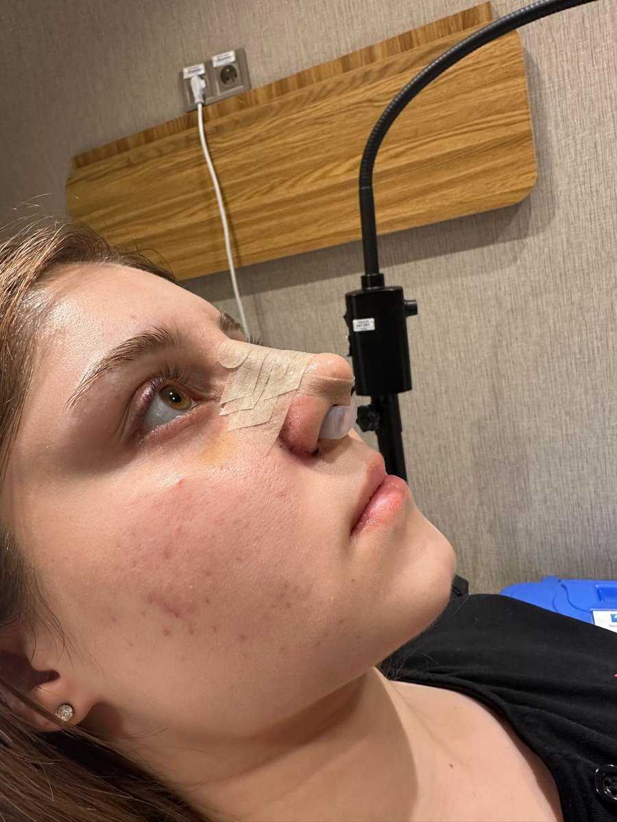 Nasenretainer für Rhinoplastik-Erholung | Nasenformer & Stützgerät aus 100% hochwertigem Silikon | Postoperative Nasenformung & Heilungshilfe (Größe 7)