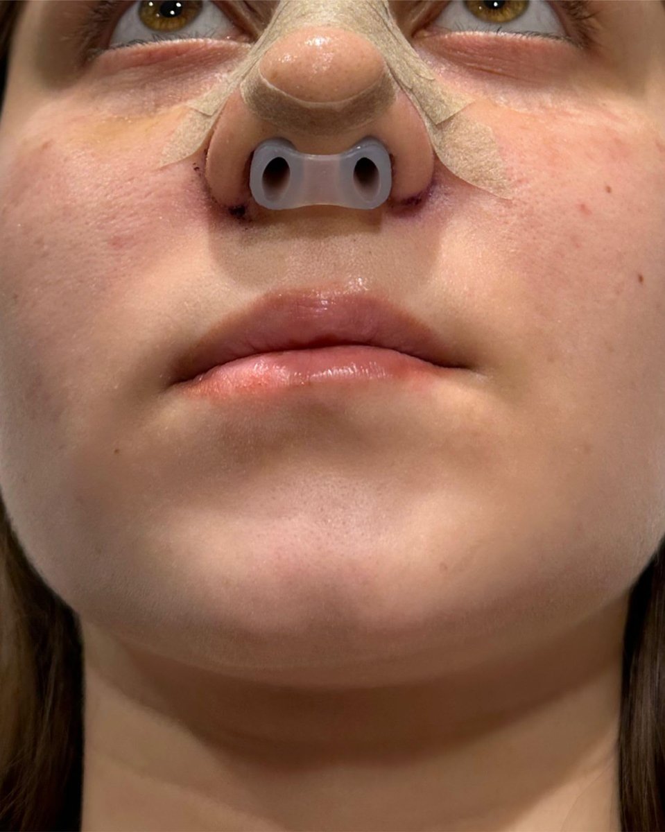 Nasenretainer für Rhinoplastik-Erholung | Nasenformer & Stützgerät aus 100% hochwertigem Silikon | Postoperative Nasenformung & Heilungshilfe (Größe 7)
