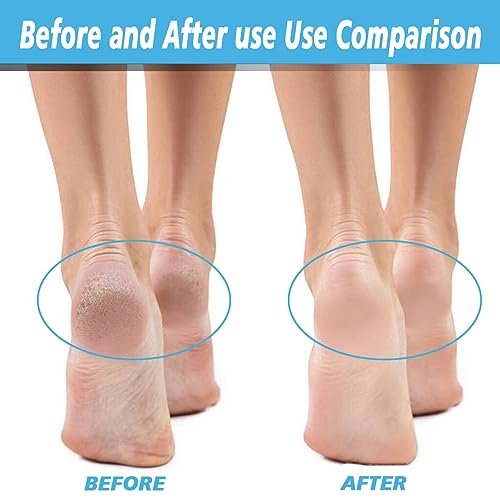 12er-Pack Ersatzrollen für Flawless Pedi – 6 extra grobe & 6 grobe Walzen, kompatibel mit Finish Touch Flawless Pedi Elektronikfeile