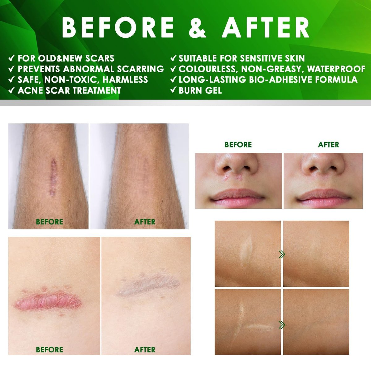 Tobcharm Fortschrittliche Keloid-Entfernung: Silikon-Keloid-Narbencreme für Piercing-, Operations-, Akne- und Verbrennungsnarben, 30 g