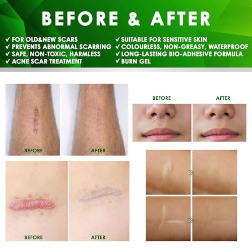 Tobcharm Fortschrittliche Keloid-Entfernung: Silikon-Keloid-Narbencreme für Piercing-, Operations-, Akne- und Verbrennungsnarben, 30 g