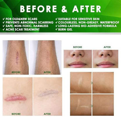 Tobcharm Fortschrittliche Keloid-Entfernung: Silikon-Keloid-Narbencreme für Piercing-, Operations-, Akne- und Verbrennungsnarben, 30 g