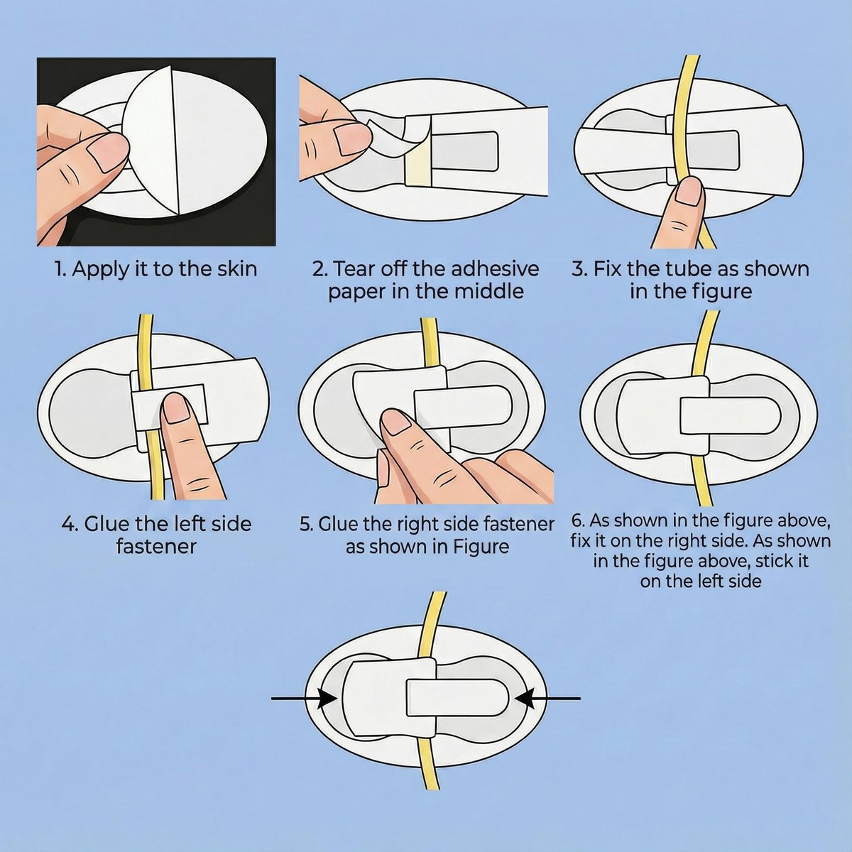 20-teiliges Katheterfixierungsset, Katheterhalter, Harnröhrenfixierungspflaster für Nephrostomie, PEG, G-Sonde, Klebeband mit Klettverschluss für Katheter, weiß