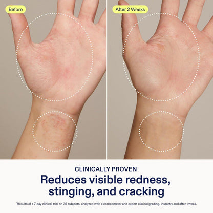 Skinfix Hand Relief Cream - 3 fl oz - Reduziert sichtbare Rötungen, Stechen und Rissbildung bei trockener, empfindlicher Haut - Von der National Eczema Association akzeptiert - Duftfrei - Vegan, tierversuchsfrei