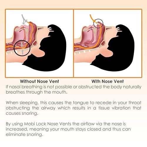 Nose Vent Sinus Relief (12er-Pack, kleine Größe) – Weiche Konus-Vents für ruhigen Schlaf – Wiederverwendbare Anti-Schnarch-Hilfe von Mobi Lock
