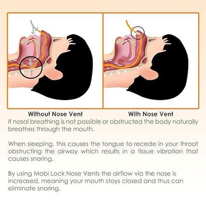 Nose Vent Sinus Relief (12er-Pack, kleine Größe) – Weiche Konus-Vents für ruhigen Schlaf – Wiederverwendbare Anti-Schnarch-Hilfe von Mobi Lock