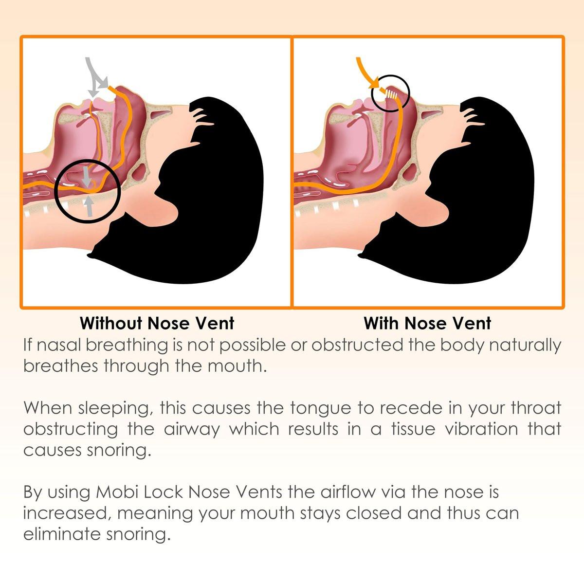 Nose Vent Sinus Relief (12er-Pack, kleine Größe) – Weiche Konus-Vents für ruhigen Schlaf – Wiederverwendbare Anti-Schnarch-Hilfe von Mobi Lock