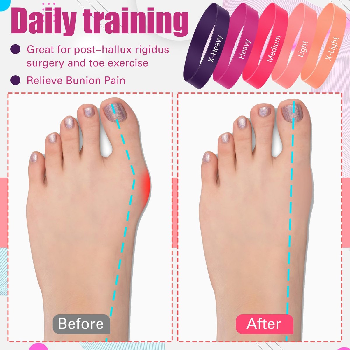 WinnerWhy Set von 5 Zehenspreizer Bänder Separator Spacer Ballenkorrektur Hallux Valgus Ausrichtung Fußstrecker Begradiger Widerstandsschleife Yoga Übung Fußpflege mit Aufbewahrungstasche (Pink)