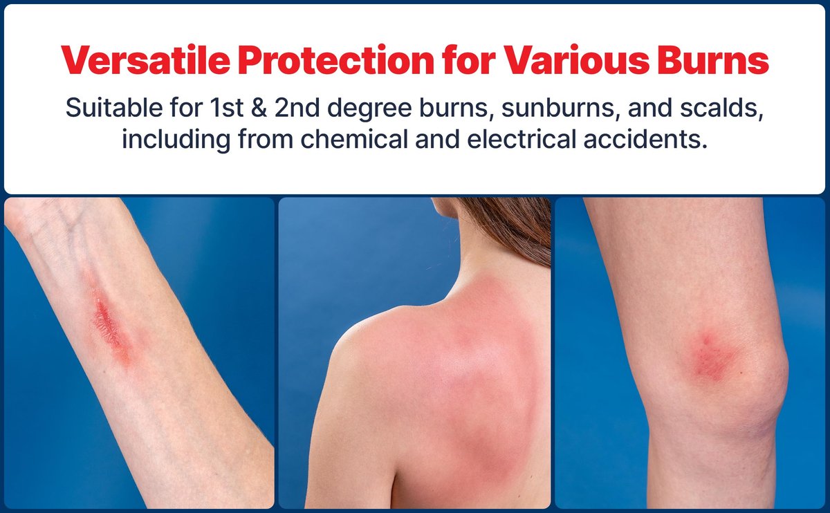 BurnFix® Hydrogel Brandspray – 120 ml Sofortige Kühlung bei Verbrennungen 1. & 2. Grades, Sonnenbrand & Verbrühungen | Arztempfohlene feuchtigkeitsspendende Erste-Hilfe für Kinder & Erwachsene