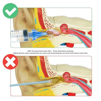 ETTSNU 20-mL-Ohrspritze zur Ohrenschmalzentfernung, Reinigungsset mit 3 Penta-Stream- und 3 Tri-Stream-Aufsätzen, verbesserte Hörklarheit und Ohrhygiene (klar)