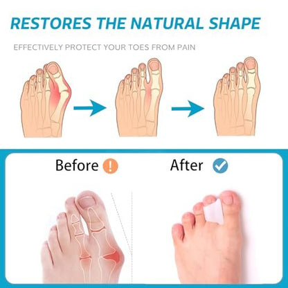 Nolimvita Hammer Toe Straightener Corrector – Zehenspacer für Ballenzehen, gekrümmte Zehen, Hammerzehen – Zehenkorrektor Zehenschiene für Männer und Frauen, 6er-Pack (Mittel)