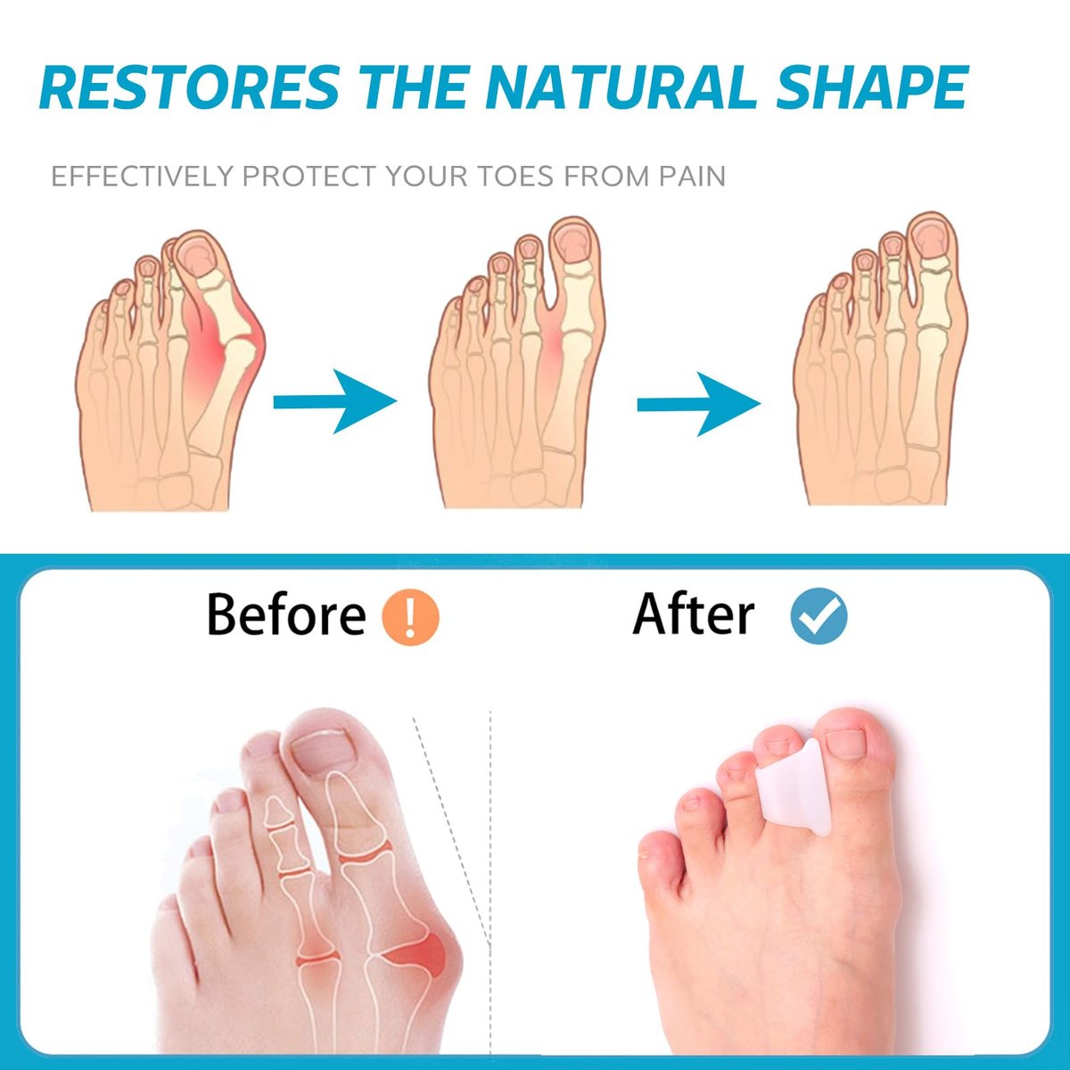 Nolimvita Hammer Toe Straightener Corrector – Zehenspacer für Ballenzehen, gekrümmte Zehen, Hammerzehen – Zehenkorrektor Zehenschiene für Männer und Frauen, 6er-Pack (Mittel)
