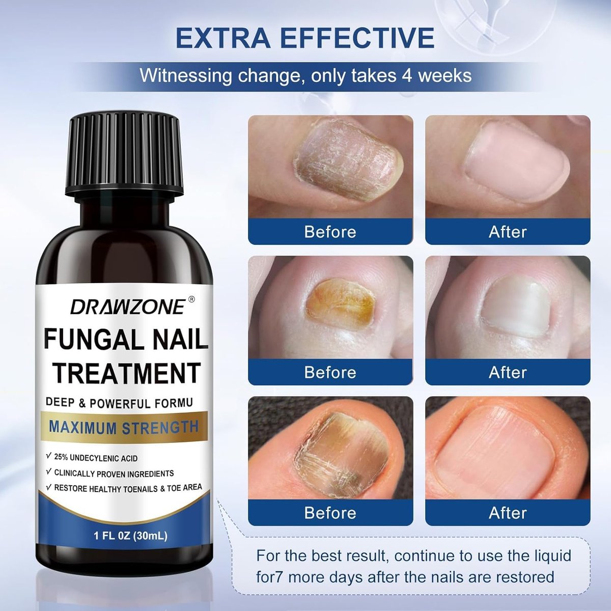 Nagelpilz Behandlung Extra Stärke mit 25% Undecylensäure – Fußpilz Behandlung, Zehennagel Reparatur, Gelbe Nägel, Beschädigte Nägel (Blau, 2er-Pack)