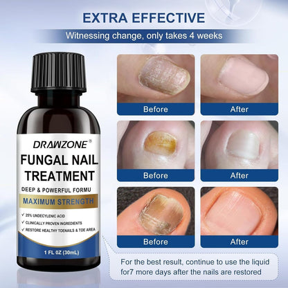 Nagelpilz Behandlung Extra Stärke mit 25% Undecylensäure – Fußpilz Behandlung, Zehennagel Reparatur, Gelbe Nägel, Beschädigte Nägel (Blau, 2er-Pack)