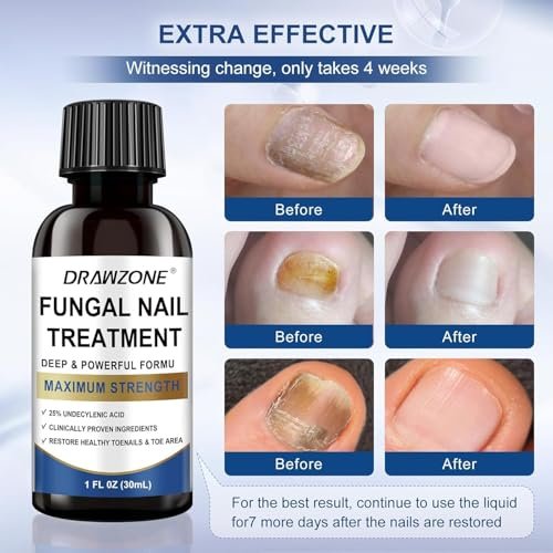 Nagelpilz Behandlung Extra Stärke mit 25% Undecylensäure – Fußpilz Behandlung, Zehennagel Reparatur, Gelbe Nägel, Beschädigte Nägel (Blau, 2er-Pack)