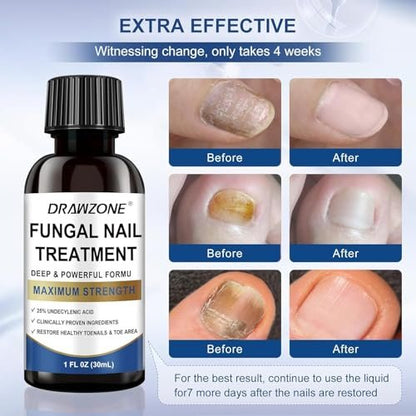Nagelpilz Behandlung Extra Stärke mit 25% Undecylensäure – Fußpilz Behandlung, Zehennagel Reparatur, Gelbe Nägel, Beschädigte Nägel (Blau, 2er-Pack)