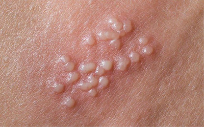 Terramed Just Think Comfort Genital Herpes Intimwaschmittel | Schnell wirkende HerpCare | Medizinisch | Lindert Juckreiz, Kribbeln & Brennen | Beruhigt Genitalherpes & Genitalbeschwerden