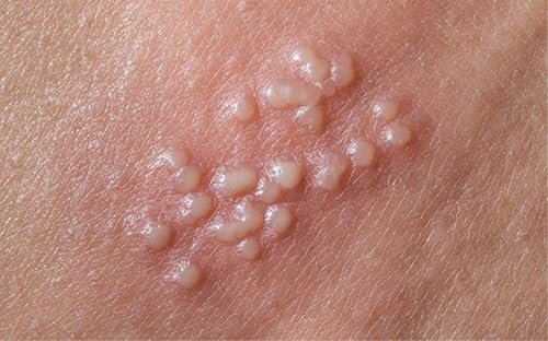Terramed Just Think Comfort Genital Herpes Intimwaschmittel | Schnell wirkende HerpCare | Medizinisch | Lindert Juckreiz, Kribbeln & Brennen | Beruhigt Genitalherpes & Genitalbeschwerden