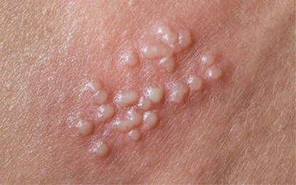 Terramed Just Think Comfort Genital Herpes Intimwaschmittel | Schnell wirkende HerpCare | Medizinisch | Lindert Juckreiz, Kribbeln & Brennen | Beruhigt Genitalherpes & Genitalbeschwerden