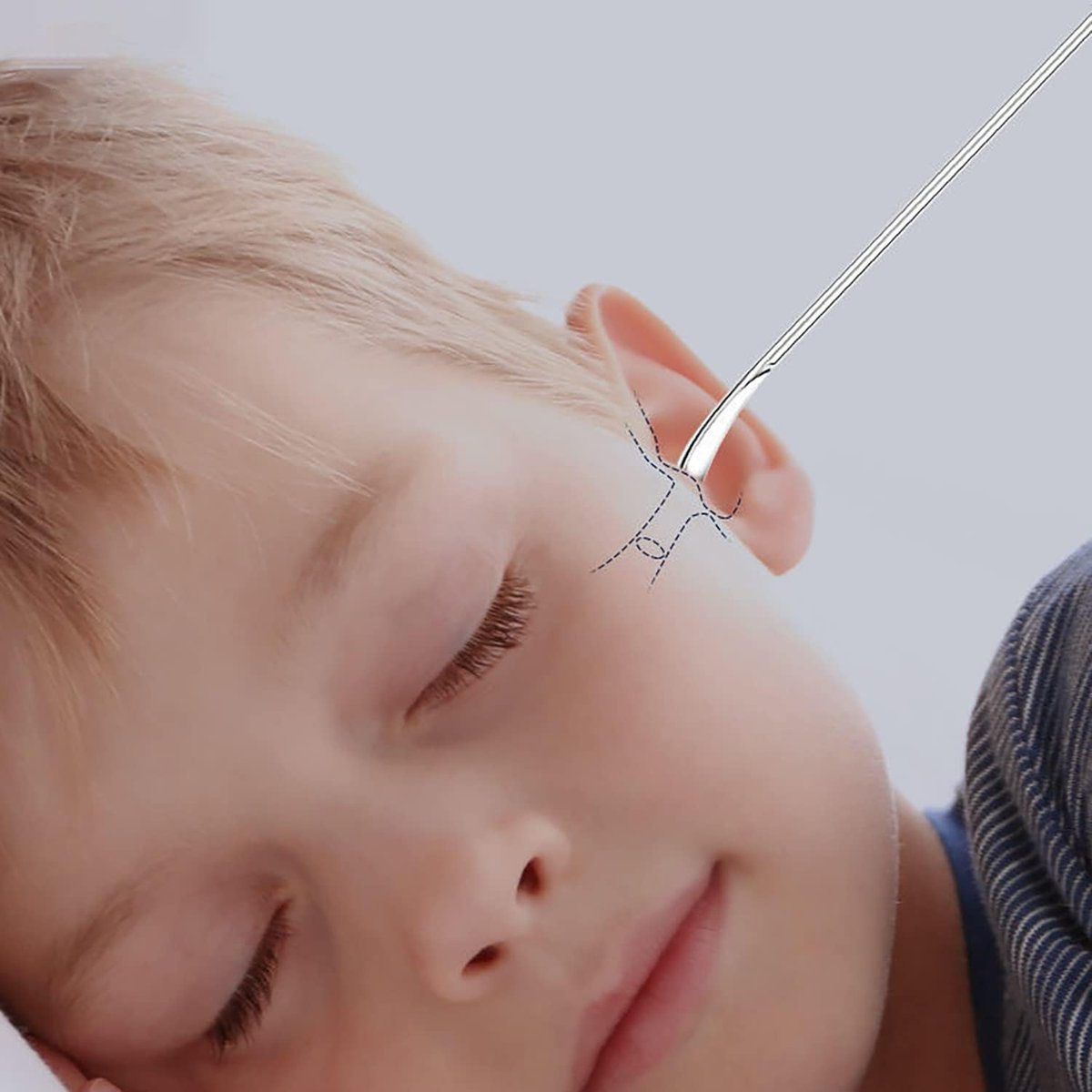 Ohrenschmalz-Entfernungsset, 6-teiliges mini tragbares Ohr-Scope mit Edelstahl 360° Spirale Ohr-Massage-Reinigungswerkzeug für Erwachsene Kinder - Ohrschmalz-Entferner mit Aufbewahrungsbox