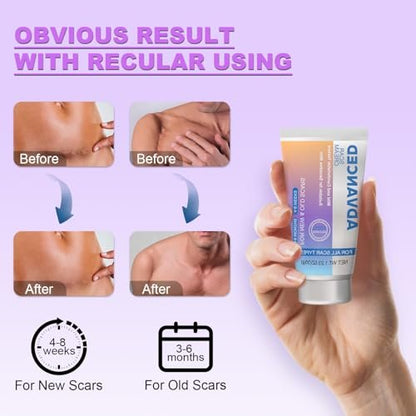 Silikon-Narbencreme Narbengel - Fortschrittliche Narbenbehandlung für Keloid-Bump-Entfernung bei chirurgischen Narben, Kaiserschnitt, Verletzungen, Dehnungsstreifen, Akne, Verbrennungen, Keloiden, alten & neuen Narben, 35 g