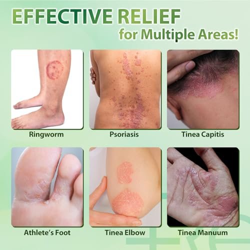 Recuren Plus Jock Itch Antifungal Creme: Teebaumöl Anti-Pilz Creme mit Aloe Vera, Lavendel & Eukalyptus – Extra starke Kräuter-Feuchtigkeitscreme zur Beruhigung juckender Haut – für Männer & Frauen, 30g