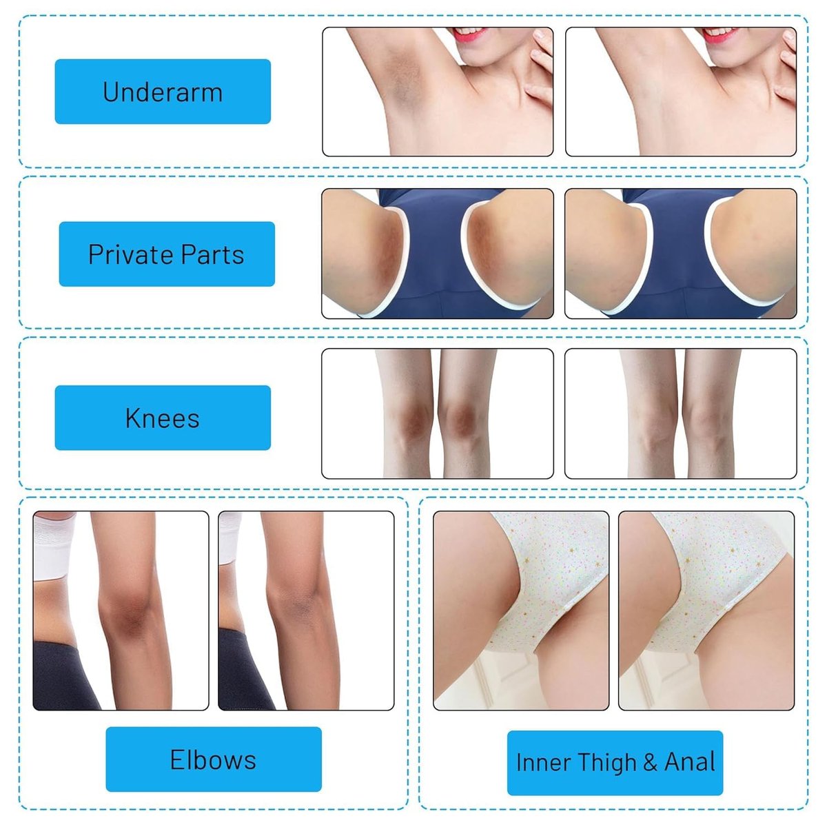 Hautaufhellungscreme für Intimbereich, Achseln, Knie, Ellbogen, Oberschenkel, Bikinizone – 60 ml