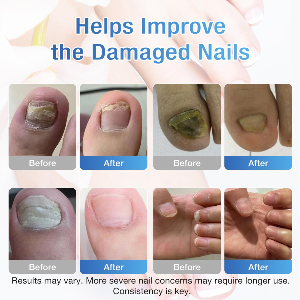 DR.RAPID Nagelpilz Behandlung Extra Stärke - 30mL Flüssigkeit & 20 Pilz-Nagelpflaster, Nagelreparatur für beschädigte Nägel, Fußpilz - Nagelpflege-Set