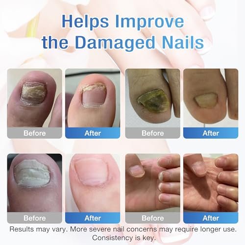 DR.RAPID Nagelpilz Behandlung Extra Stärke - 30mL Flüssigkeit & 20 Pilz-Nagelpflaster, Nagelreparatur für beschädigte Nägel, Fußpilz - Nagelpflege-Set