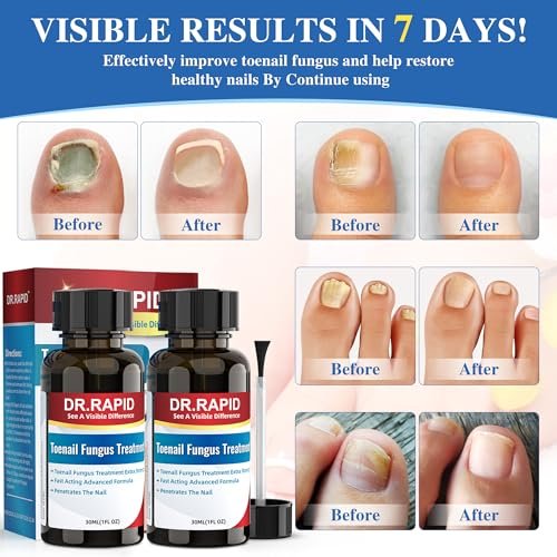DR.RAPID Nagelpilz Behandlung Extra Stark – Effektive antimykotische Nagelreparatur mit Teebaumöl, schnelle Wirkung bei beschädigten Nägeln & eingewachsenen Zehennägeln – 60 ml (2 x 30 ml)
