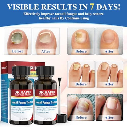 DR.RAPID Nagelpilz Behandlung Extra Stark – Effektive antimykotische Nagelreparatur mit Teebaumöl, schnelle Wirkung bei beschädigten Nägeln & eingewachsenen Zehennägeln – 60 ml (2 x 30 ml)