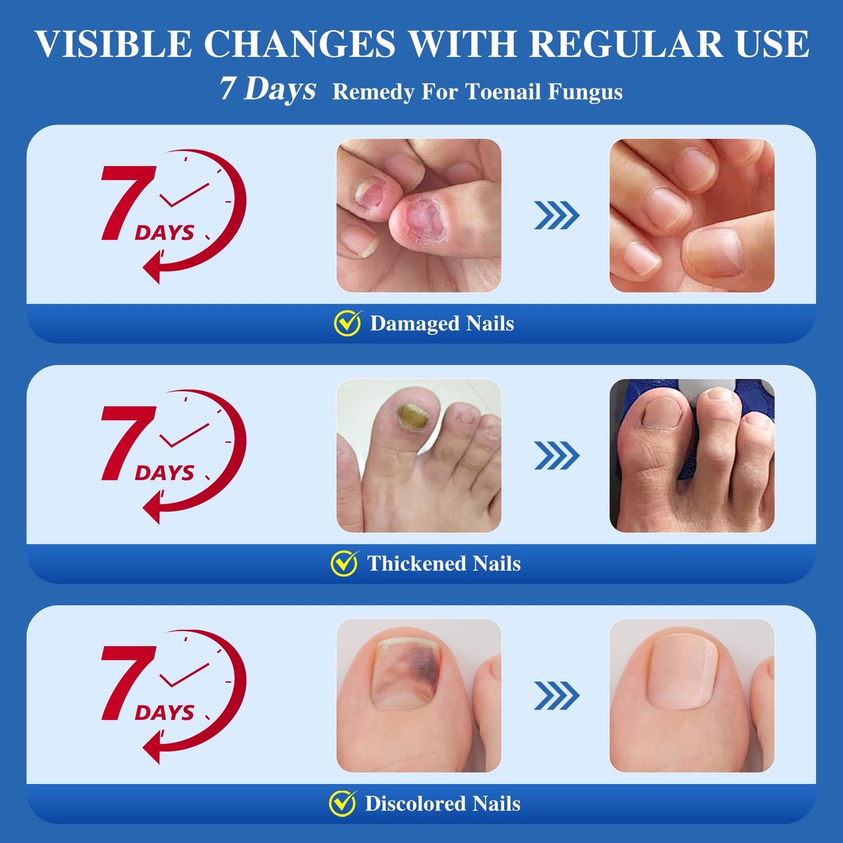 DR.RAPID Nagelpilz Behandlung Extra Stark – Effektive antimykotische Nagelreparatur mit Teebaumöl, schnelle Wirkung bei beschädigten Nägeln & eingewachsenen Zehennägeln – 60 ml (2 x 30 ml)