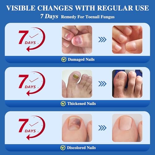 DR.RAPID Nagelpilz Behandlung Extra Stark – Effektive antimykotische Nagelreparatur mit Teebaumöl, schnelle Wirkung bei beschädigten Nägeln & eingewachsenen Zehennägeln – 60 ml (2 x 30 ml)