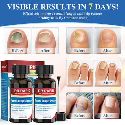 DR.RAPID Nagelpilz Behandlung Extra Stark – Effektive antimykotische Nagelreparatur mit Teebaumöl, schnelle Wirkung bei beschädigten Nägeln & eingewachsenen Zehennägeln – 60 ml (2 x 30 ml)