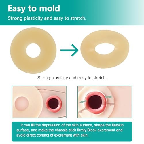 Vlookup Stoma-Barrier-Ringe – Außendurchmesser 2" (50mm), 4mm Dicke, formbare Ostomie-Ringe, Hydrokolloid-Hautschutzringe für Kolostomiebeutel, 10 Stück