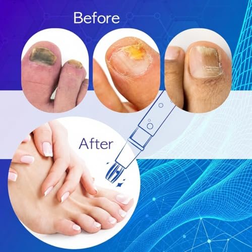 NEOMEN Nagelpilz Stift – Behandlung für Zehen- und Fingernägel, tägliche Nagelpflege, 4er-Pack