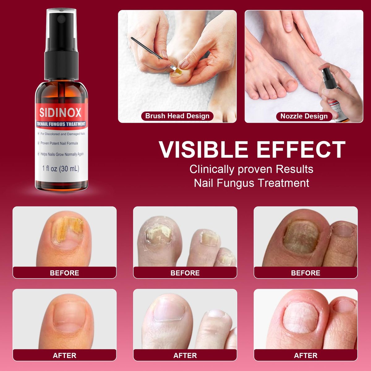 Nagelpilz Behandlung Extra Stark mit 25% Undecylensäure – 5er-Pack (5x30 ml) für beschädigte, verfärbte und verdickte Nägel