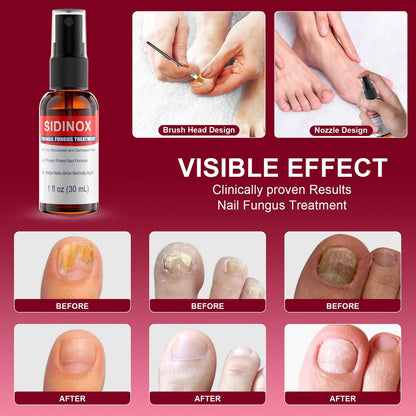 Nagelpilz Behandlung Extra Stark mit 25% Undecylensäure – 5er-Pack (5x30 ml) für beschädigte, verfärbte und verdickte Nägel