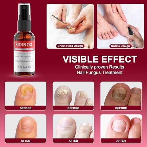 Nagelpilz Behandlung Extra Stark mit 25% Undecylensäure – 5er-Pack (5x30 ml) für beschädigte, verfärbte und verdickte Nägel