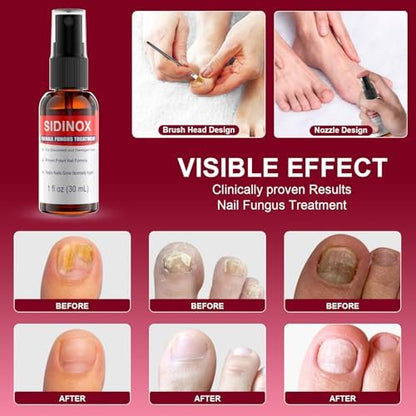 Nagelpilz Behandlung Extra Stark mit 25% Undecylensäure – 5er-Pack (5x30 ml) für beschädigte, verfärbte und verdickte Nägel