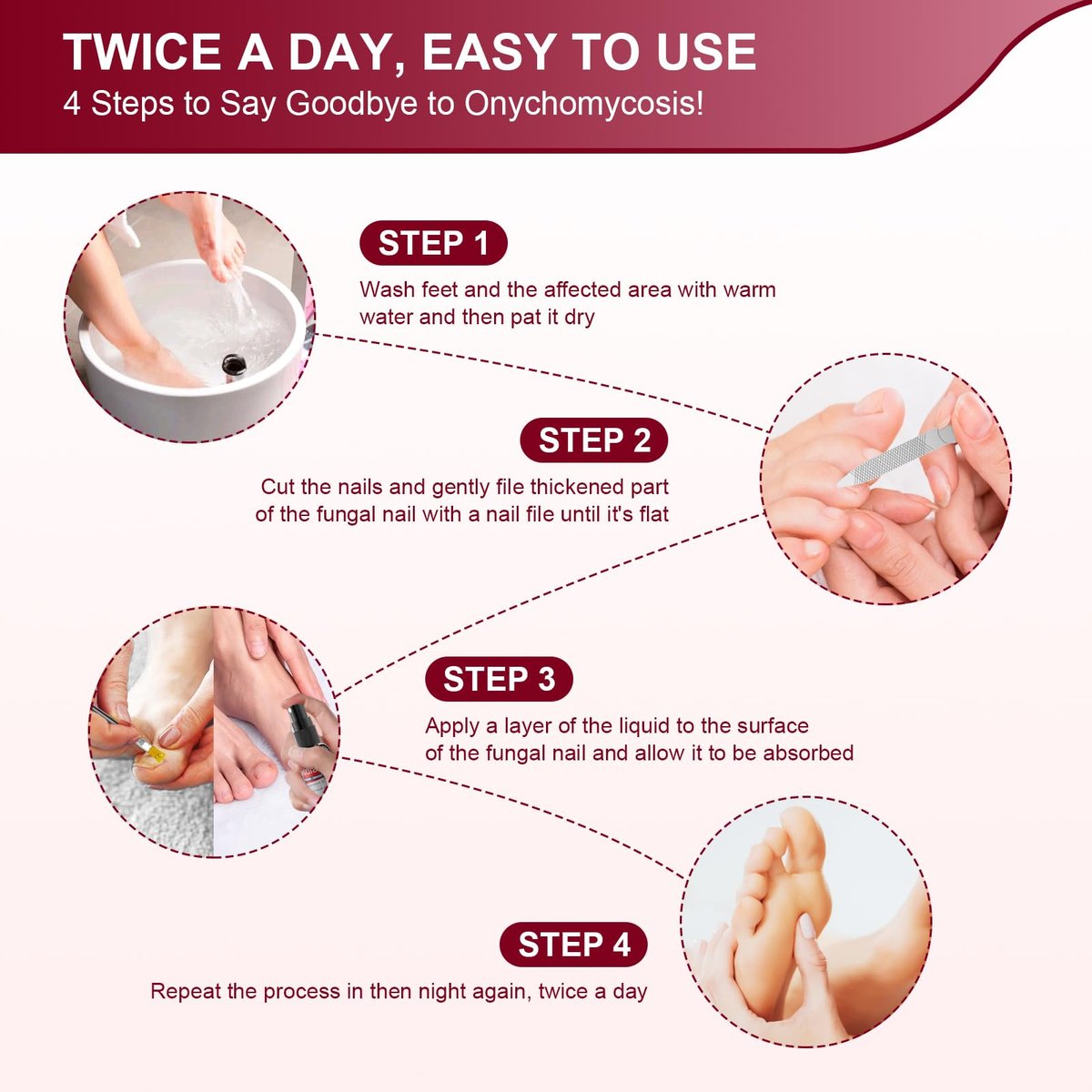 Nagelpilz Behandlung Extra Stark mit 25% Undecylensäure – 5er-Pack (5x30 ml) für beschädigte, verfärbte und verdickte Nägel