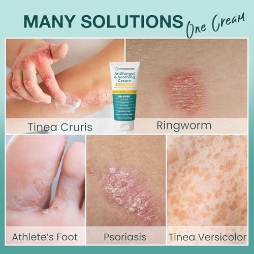 Antimykotische Creme gegen Juckreiz, Ringelflechte, Psoriasis und Fußpilz – Extra starke Linderung für juckende, brennende Haut – Schnell wirkende Formel bei Tinea cruris, Tinea versicolor und Hautirritationen