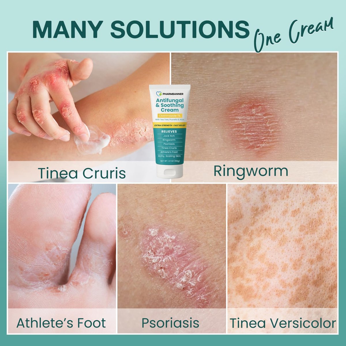 Antimykotische Creme gegen Juckreiz, Ringelflechte, Psoriasis und Fußpilz – Extra starke Linderung für juckende, brennende Haut – Schnell wirkende Formel bei Tinea cruris, Tinea versicolor und Hautirritationen
