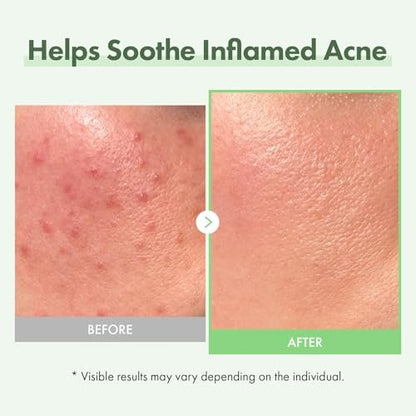 TOSOWOONG Azelainsäure 10% Gesichtsserum – Rötungen lindern, Rosacea-Pflege, Centella Asiatica & Niacinamid für unreine Haut, 33 ml