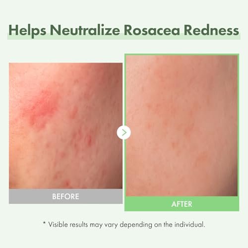 TOSOWOONG Azelainsäure 10% Gesichtsserum – Rötungen lindern, Rosacea-Pflege, Centella Asiatica & Niacinamid für unreine Haut, 33 ml
