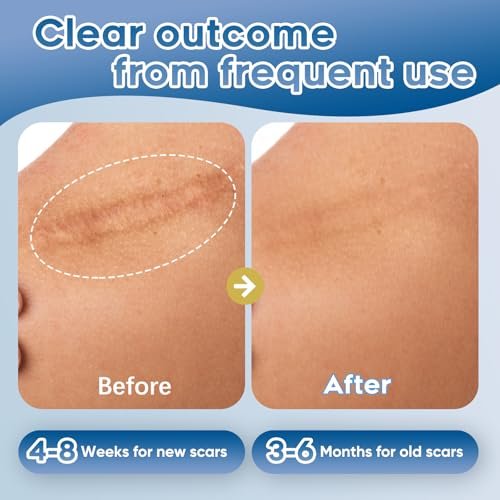 Glowor Silikon-Gel für Narben – Fortschrittliche Narbencreme für Gesicht & Körper – Reduziert das Erscheinungsbild von alten & neuen Narben, Aknenarben, Operationsnarben, Verbrennungen, Verletzungen, Kaiserschnittnarben – 100 g