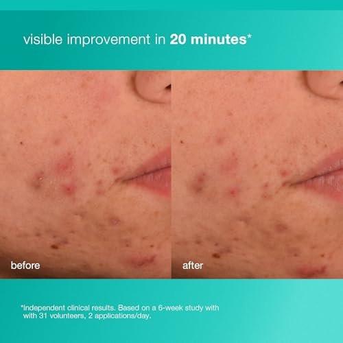 Dermalogica Acne Biotic Feuchtigkeitscreme – Leichte Tageslotion gegen Hautalterung und Unreinheiten, 50 ml